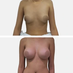 تكبير الثدي تكبير الصدر تجميل الثدي تجميل الصدر